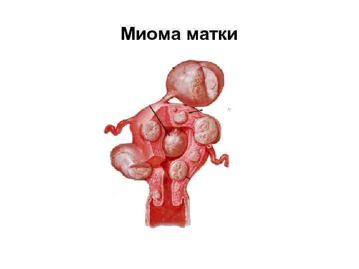 Миома матки 