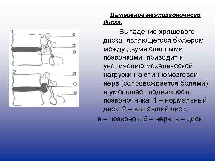    Выпадение межпозвоночного диска.    Выпадение хрящевого диска, являющегося буфером