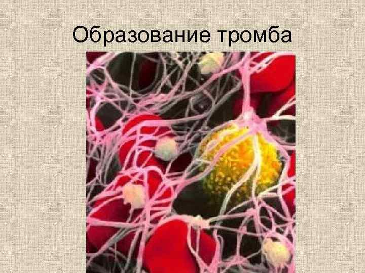 Образование тромба 