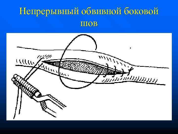 Непрерывный обвивной боковой   шов 