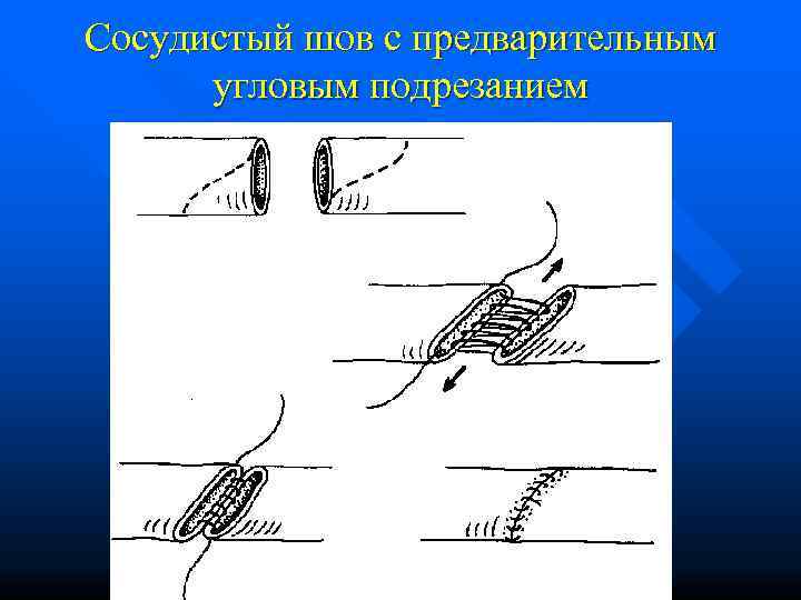 Сосудистый шов с предварительным  угловым подрезанием 