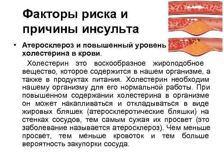  Факторы риска и  причины инсульта • Атеросклероз и повышенный уровень холестерина в