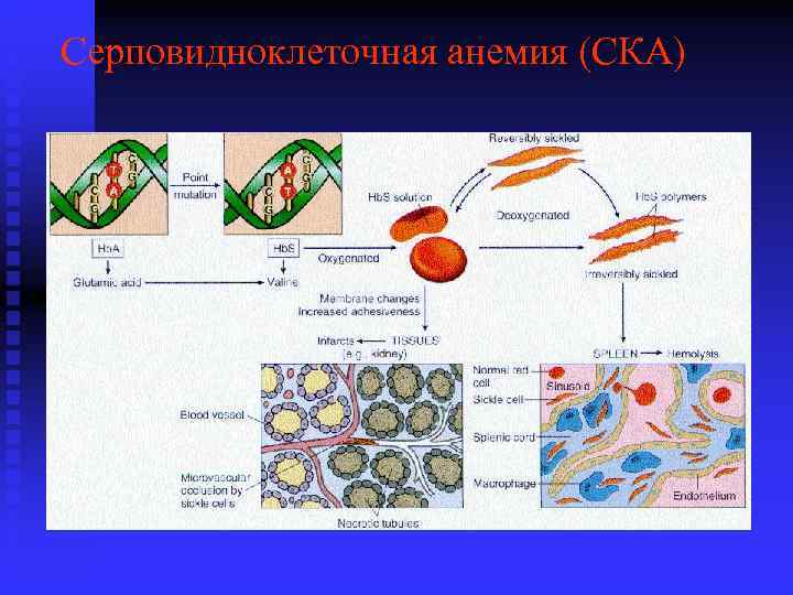 Серповидноклеточная анемия (СКА) 