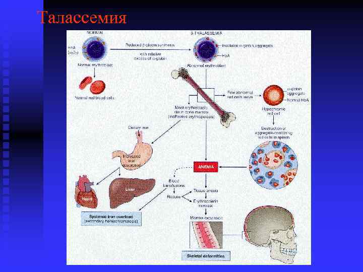Талассемия 