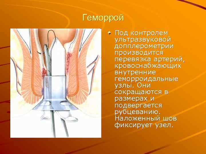 Геморрой  Под контролем  ультразвуковой  допплерометрии  производится  перевязка артерий, 