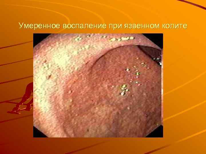 Умеренное воспаление при язвенном колите 