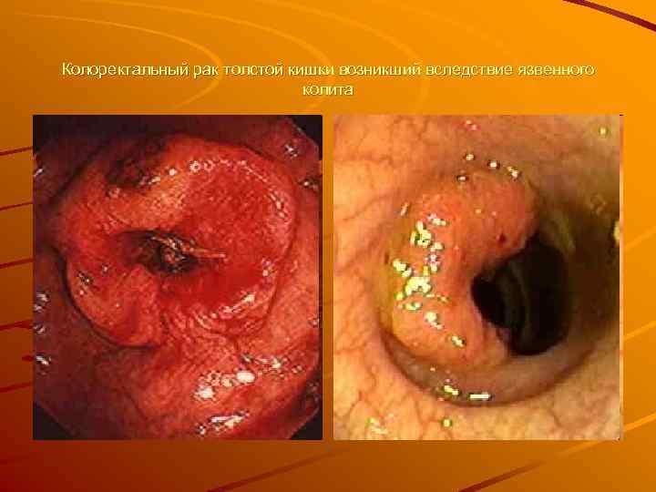 Колоректальный рак толстой кишки возникший вследствие язвенного     колита 