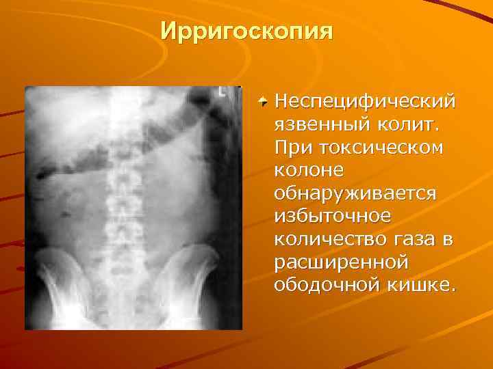 Ирригоскопия   Неспецифический  язвенный колит.   При токсическом  колоне 