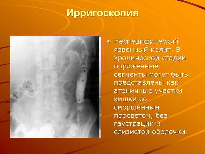 Ирригоскопия подготовка отзывы