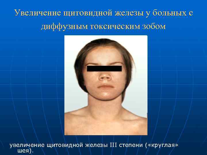  Увеличение щитовидной железы у больных с  диффузным токсическим зобом увеличение щитовидной железы