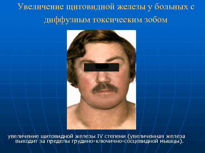   Увеличение щитовидной железы у больных с   диффузным токсическим зобом увеличение