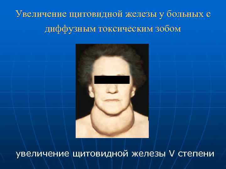 Увеличение щитовидной железы у больных с  диффузным токсическим зобом увеличение щитовидной железы V