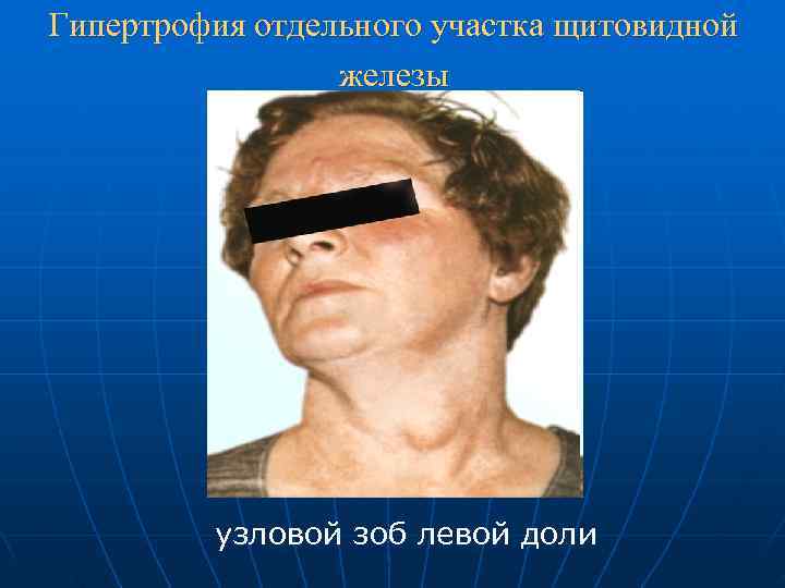 Гипертрофия отдельного участка щитовидной   железы   узловой зоб левой доли 