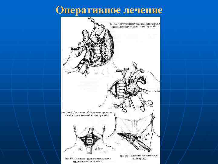 Оперативное лечение 