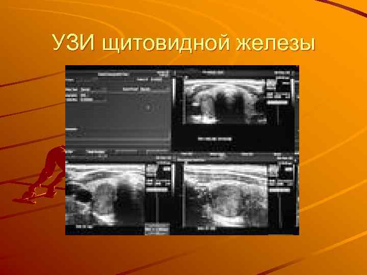 УЗИ щитовидной железы 