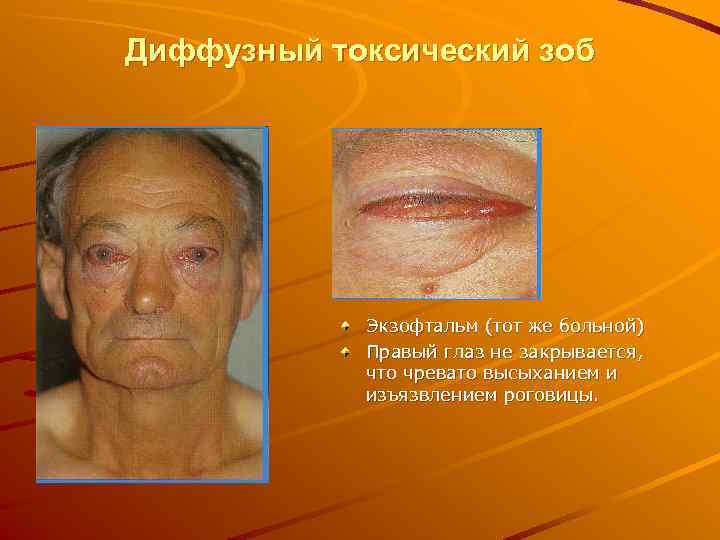 Диффузный токсический зоб   Экзофтальм (тот же больной)   Правый глаз не