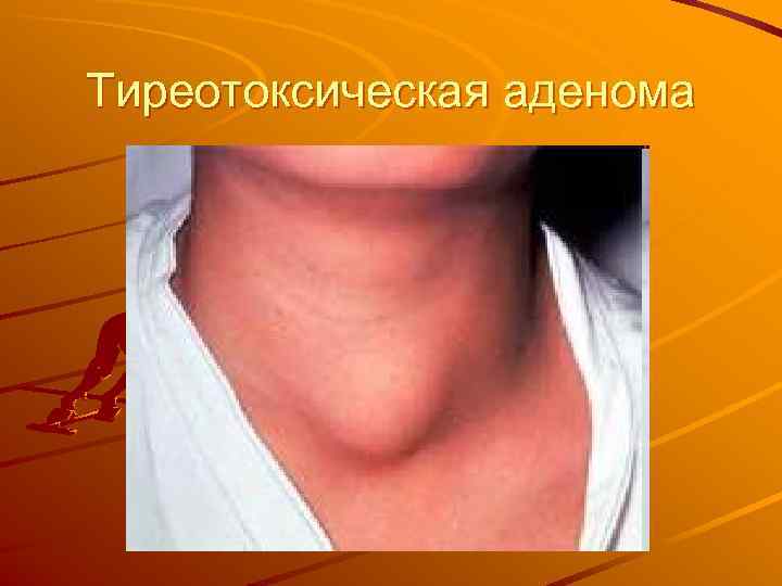 Тиреотоксическая аденома 