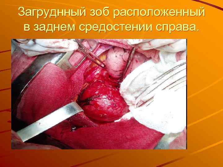 Загруднный зоб расположенный в заднем средостении справа. 