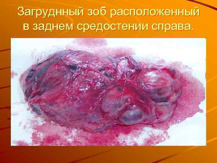 Загруднный зоб расположенный в заднем средостении справа. 