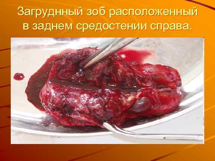 Загруднный зоб расположенный в заднем средостении справа. 