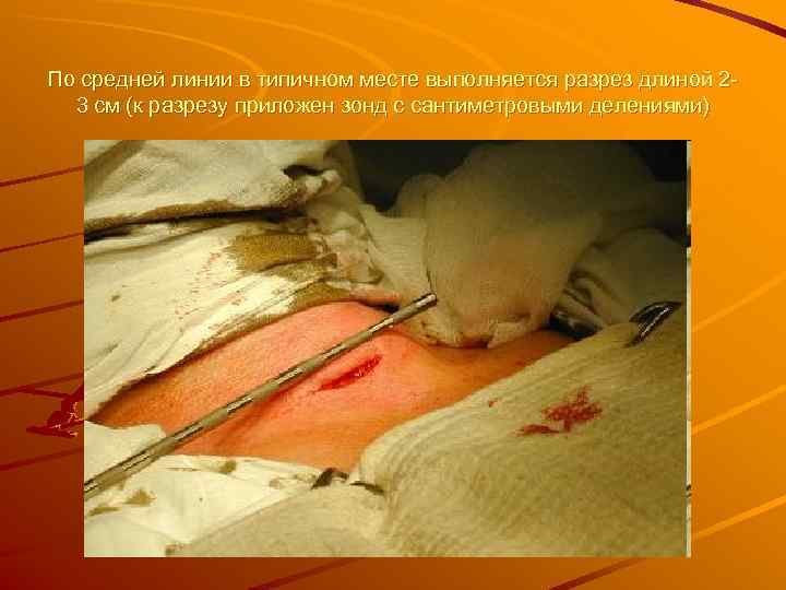 По средней линии в типичном месте выполняется разрез длиной 2 -  3 см