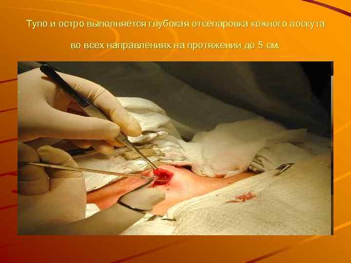Тупо и остро выполняется глубокая отсепаровка кожного лоскута  во всех направлениях на протяжении