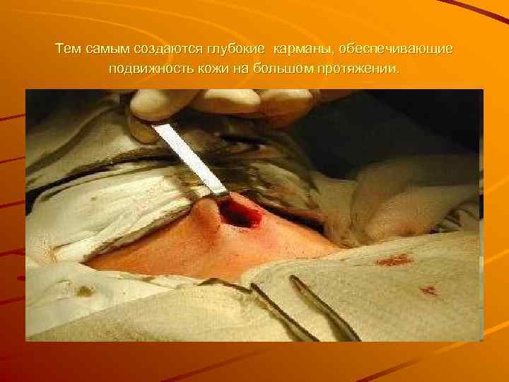 Тем самым создаются глубокие карманы, обеспечивающие  подвижность кожи на большом протяжении. 