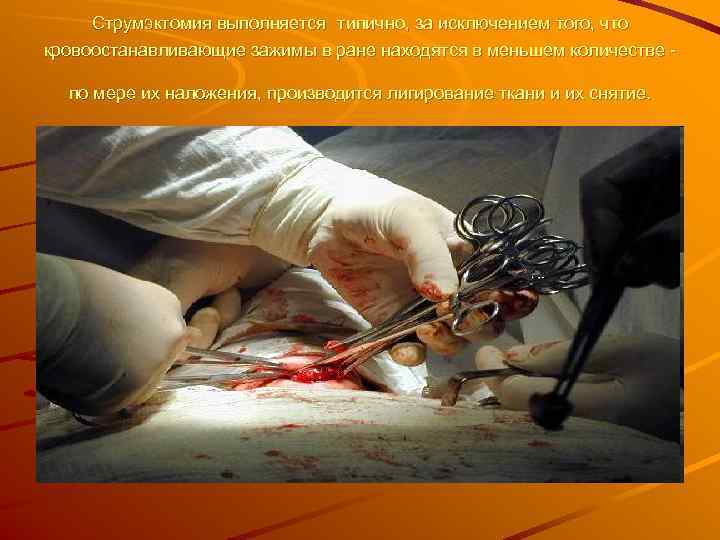  Струмэктомия выполняется типично, за исключением того, что кровоостанавливающие зажимы в ране находятся в