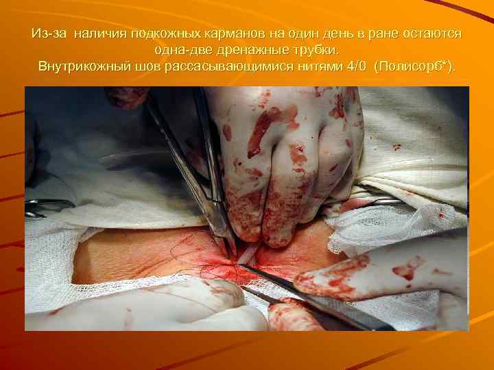 Из-за наличия подкожных карманов на один день в ране остаются   одна-две дренажные