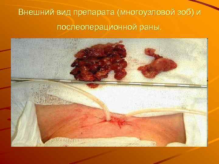 Внешний вид препарата (многоузловой зоб) и   послеоперационной раны. 