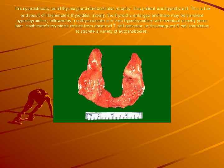 This symmetrically small thyroid gland demonstrates atrophy. This patient was hypothyroid. This is the