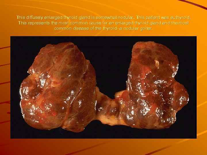 This diffusely enlarged thyroid gland is somewhat nodular. This patient was euthyroid.  This
