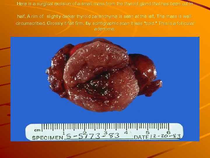 Here is a surgical excision of a small mass from the thyroid gland that