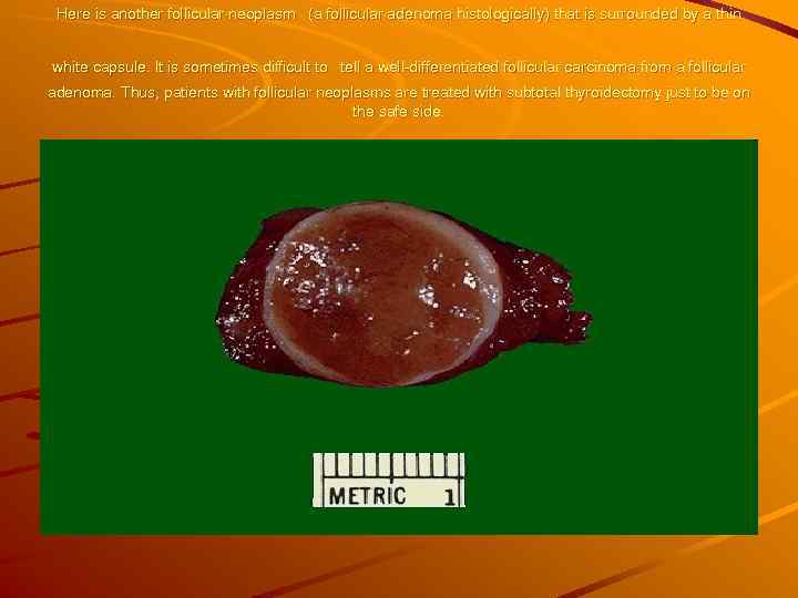  Here is another follicular neoplasm (a follicular adenoma histologically) that is surrounded by