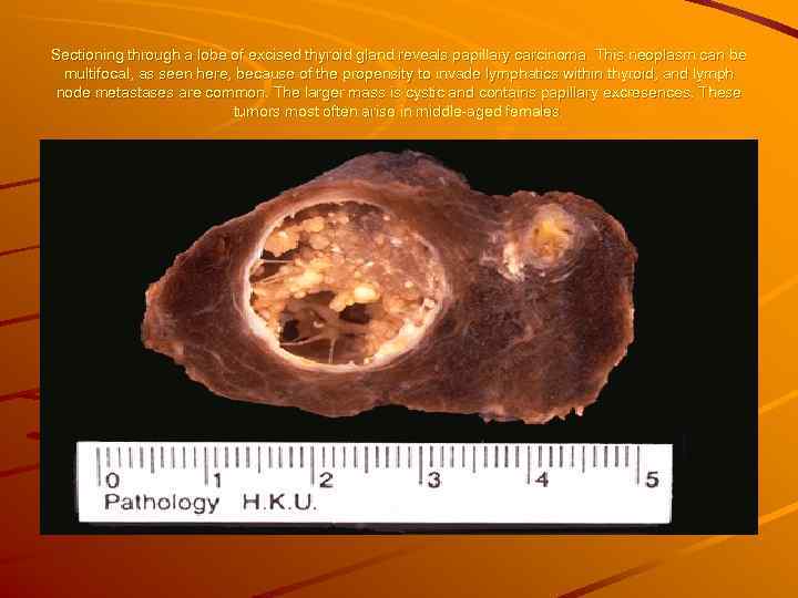 Sectioning through a lobe of excised thyroid gland reveals papillary carcinoma. This neoplasm can