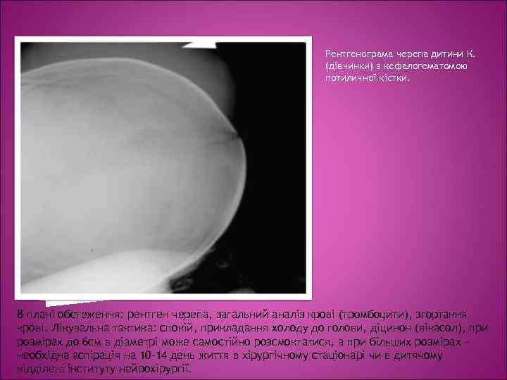      Рентгенограма черепа дитини К.     