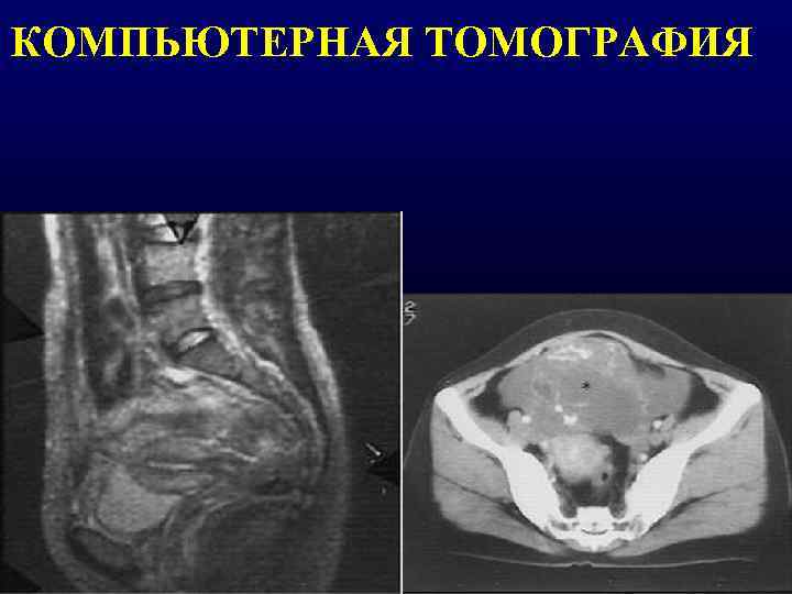 КОМПЬЮТЕРНАЯ ТОМОГРАФИЯ 