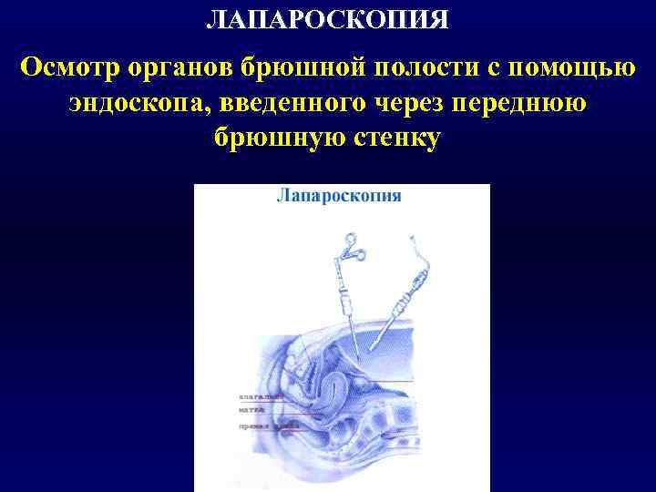   ЛАПАРОСКОПИЯ Осмотр органов брюшной полости с помощью  эндоскопа, введенного через переднюю
