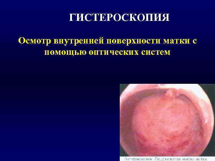    ГИСТЕРОСКОПИЯ Осмотр внутренней поверхности матки с помощью оптических систем 