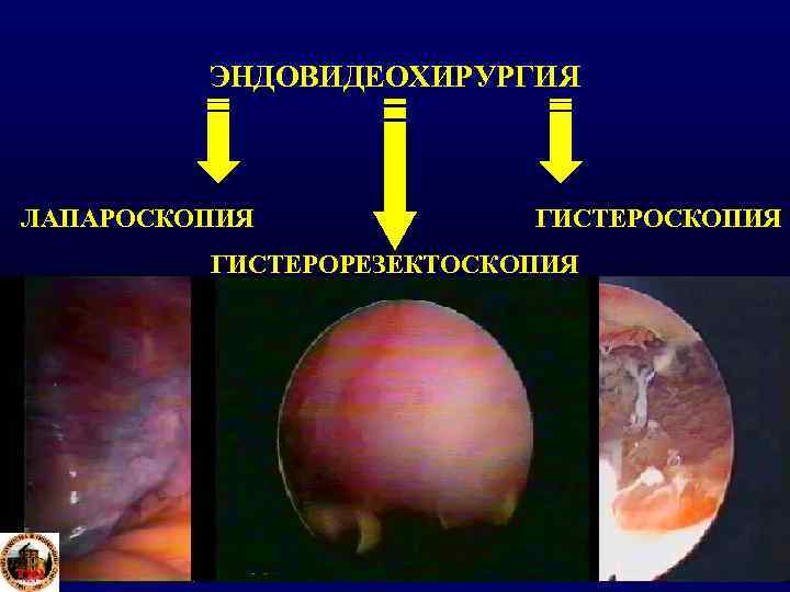    ЭНДОВИДЕОХИРУРГИЯ  ЛАПАРОСКОПИЯ   ГИСТЕРОРЕЗЕКТОСКОПИЯ 