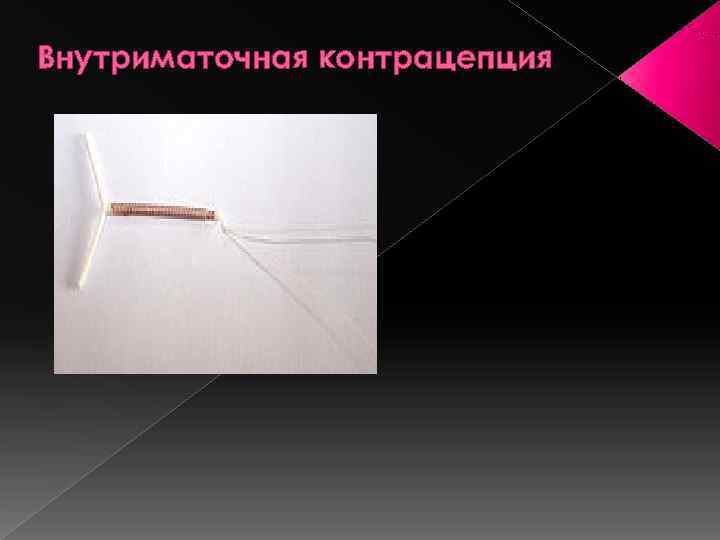Внутриматочная контрацепция 