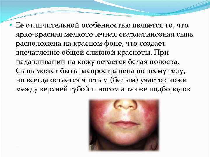 • Ее отличительной особенностью является то, что ярко-красная мелкоточечная скарлатинозная сыпь • Ее отличительной особенностью является то, что ярко-красная мелкоточечная скарлатинозная сыпь