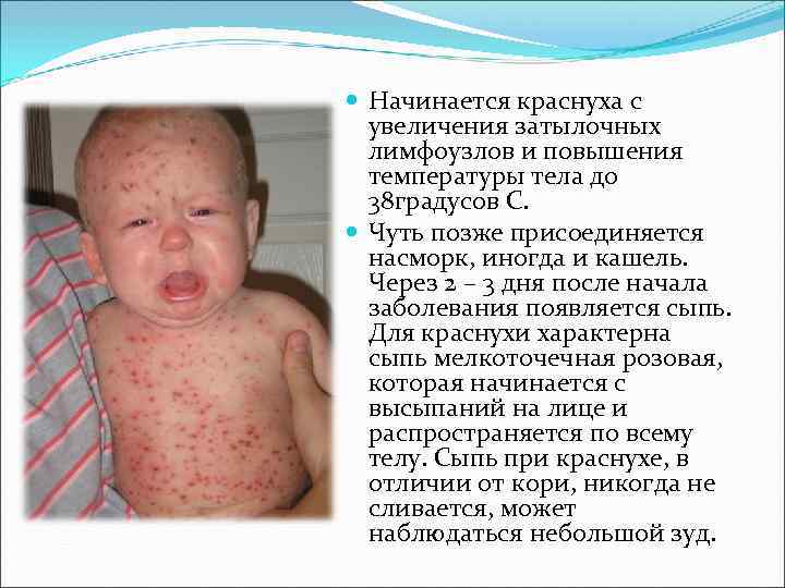 Начинается краснуха с увеличения затылочных лимфоузлов и повышения температуры тела Начинается краснуха с увеличения затылочных лимфоузлов и повышения температуры тела