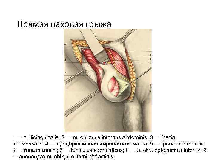  Прямая паховая грыжа 1 — n. ilioinguinalis; 2 — m. obliquus internus abdominis;