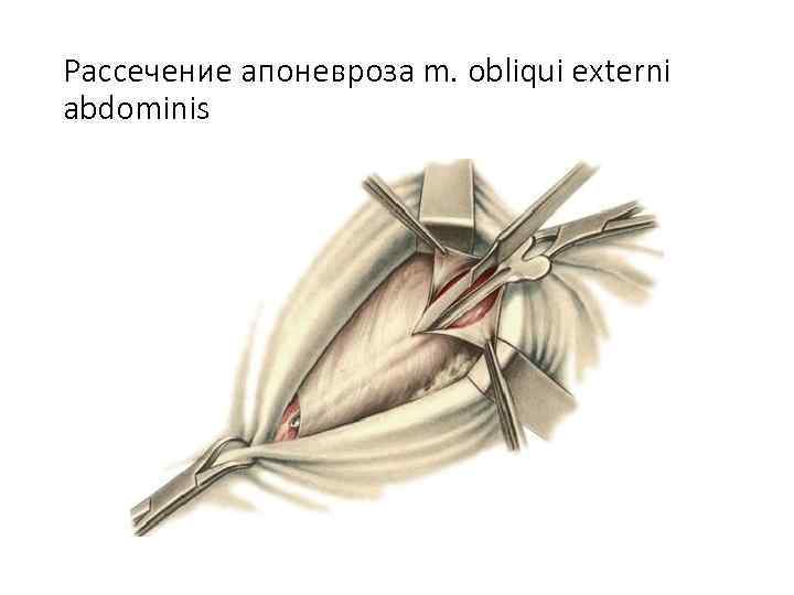 Рассечение апоневроза m. obliqui externi abdominis 