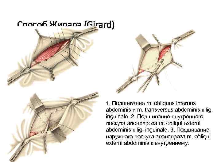 Способ Жирара (Girard)    1. Подшивание m. obliquus internus   
