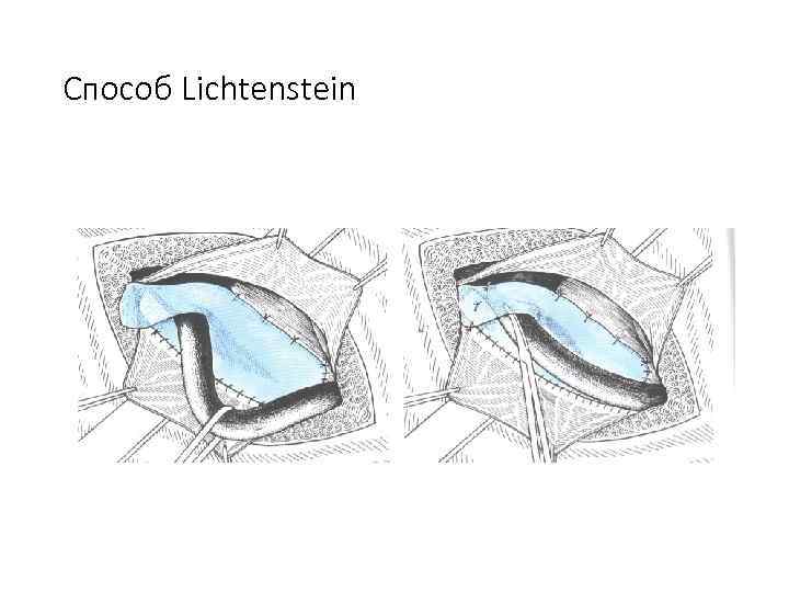 Способ Lichtenstein 