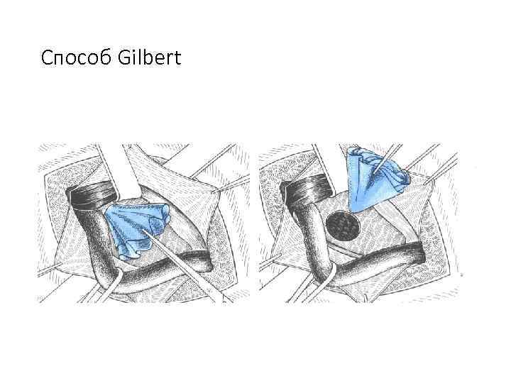 Способ Gilbert 