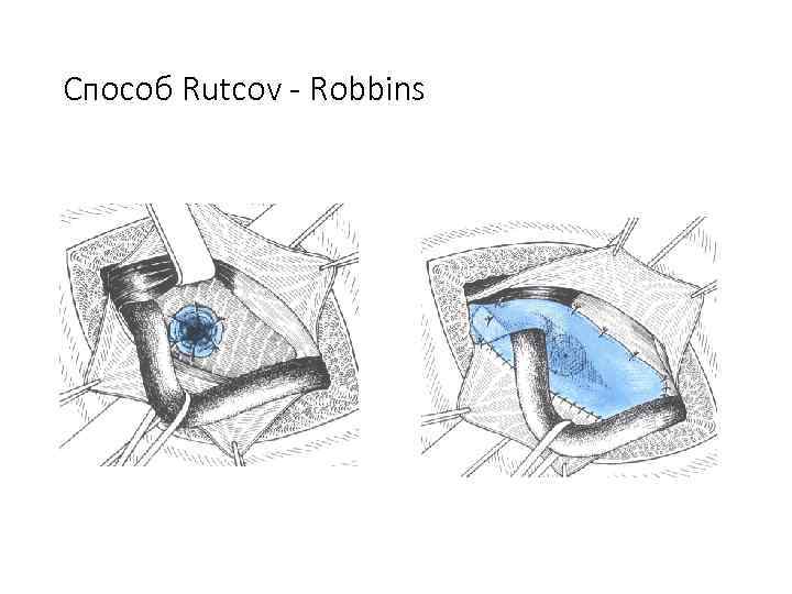 Способ Rutcov - Robbins 
