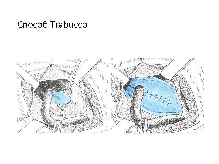 Способ Trabucco 